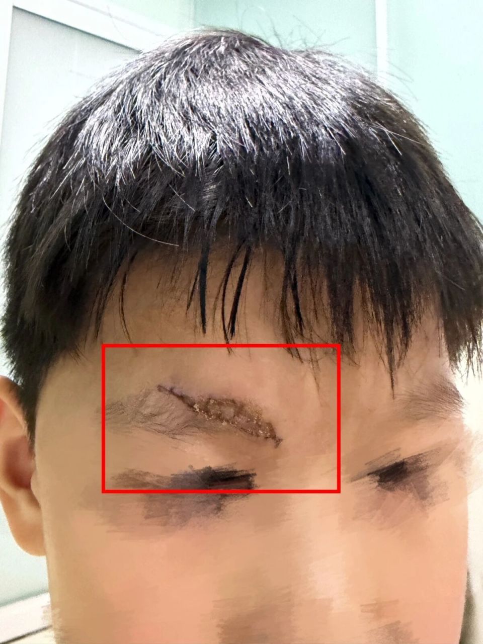 男童游乐场摔伤家长索祛疤费遭拒 男童游乐场摔伤家长索祛疤费遭拒