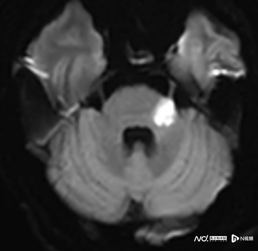 年轻人脑卒中发病率逐步增加 年轻人脑卒中发病率逐步增加