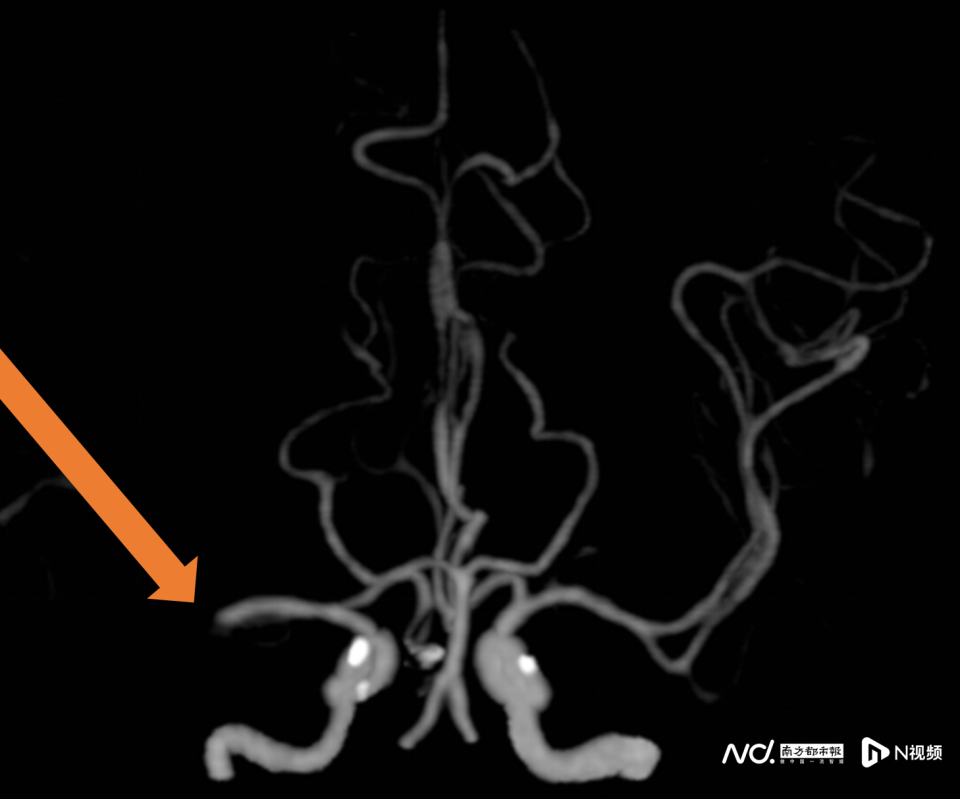年轻人脑卒中发病率逐步增加 年轻人脑卒中发病率逐步增加