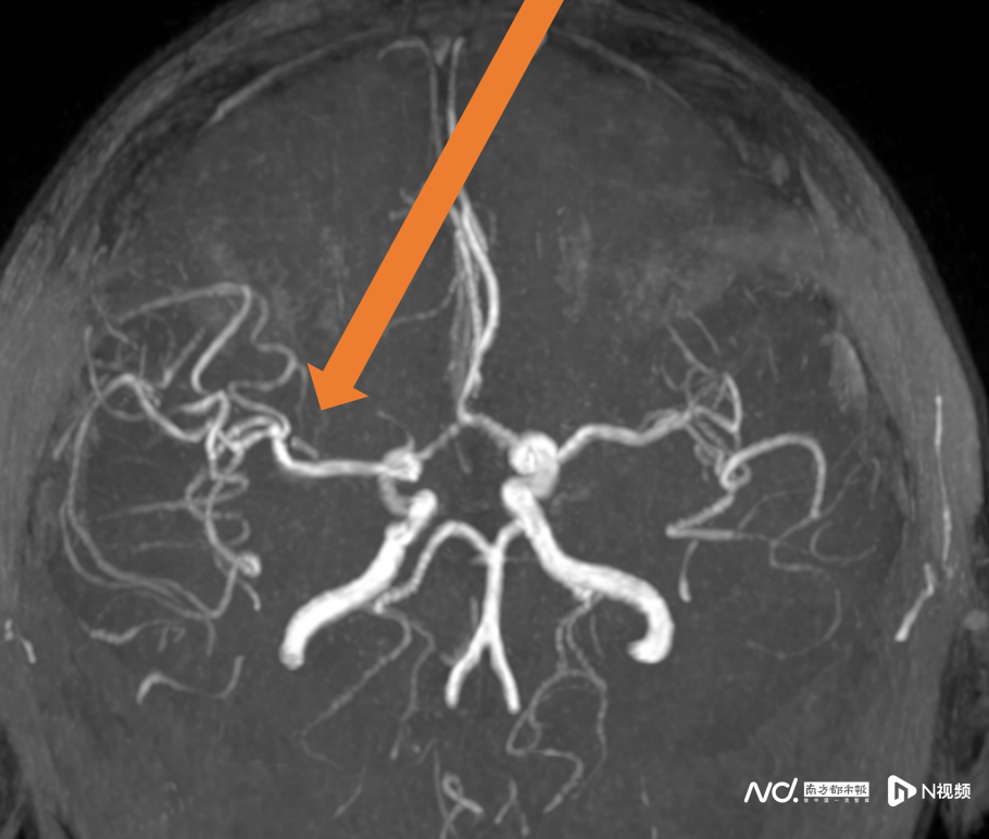 年轻人脑卒中发病率逐步增加 年轻人脑卒中发病率逐步增加