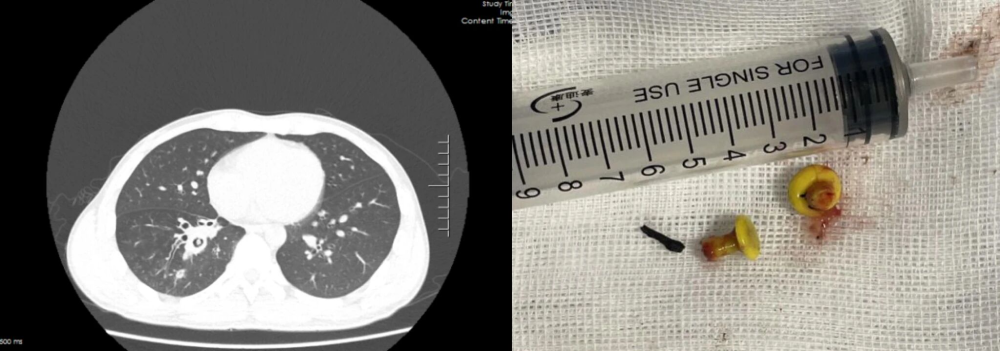 铁钉在男子支气管内10年被取出