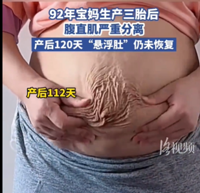 92年宝妈产后腹直肌严重分离