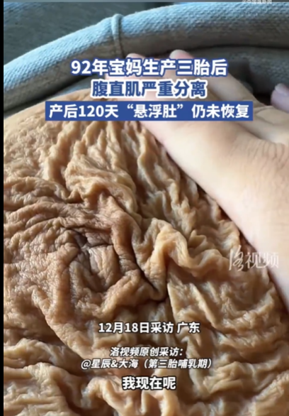 92年宝妈产后腹直肌严重分离