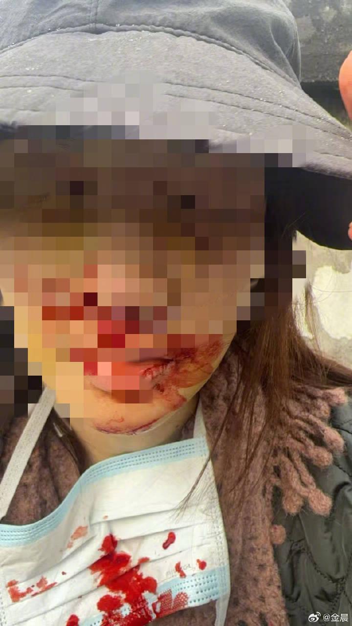 金晨公布車禍受傷照片
